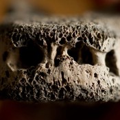 Modern disease found in ancient bones