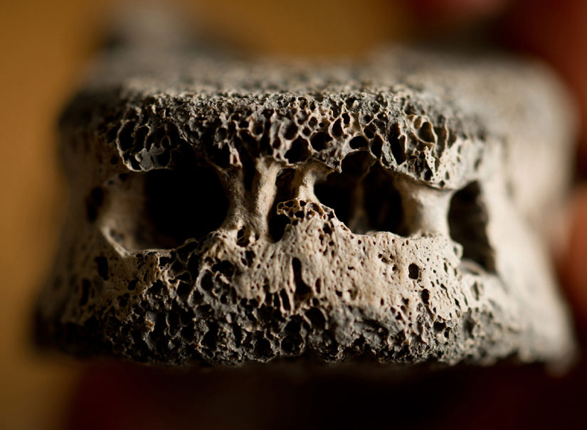 Modern disease found in ancient bones
