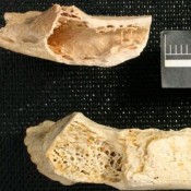 The oldest tumour found in the human fossil record