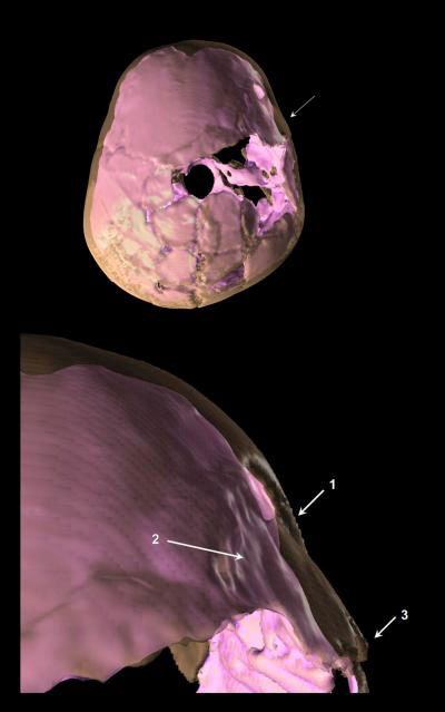 3-D image of Paleolithic child’s skull reveals trauma, brain damage