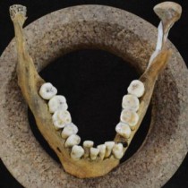 Hunter-gatherers’ dental “harmony” disrupted by diet shift