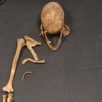 Ancient skeleton shows leprosy may have spread to Britain from Scandinavia