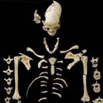 Oldest case of leukemia in prehistoric skeleton