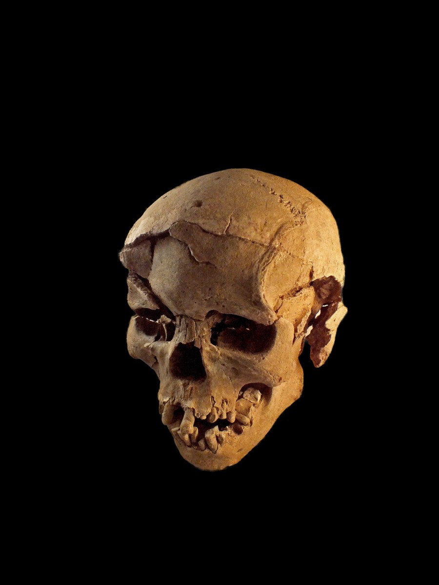Skull with multiple lesions on front and left side, consistent with wounds from a blunt implement. 
