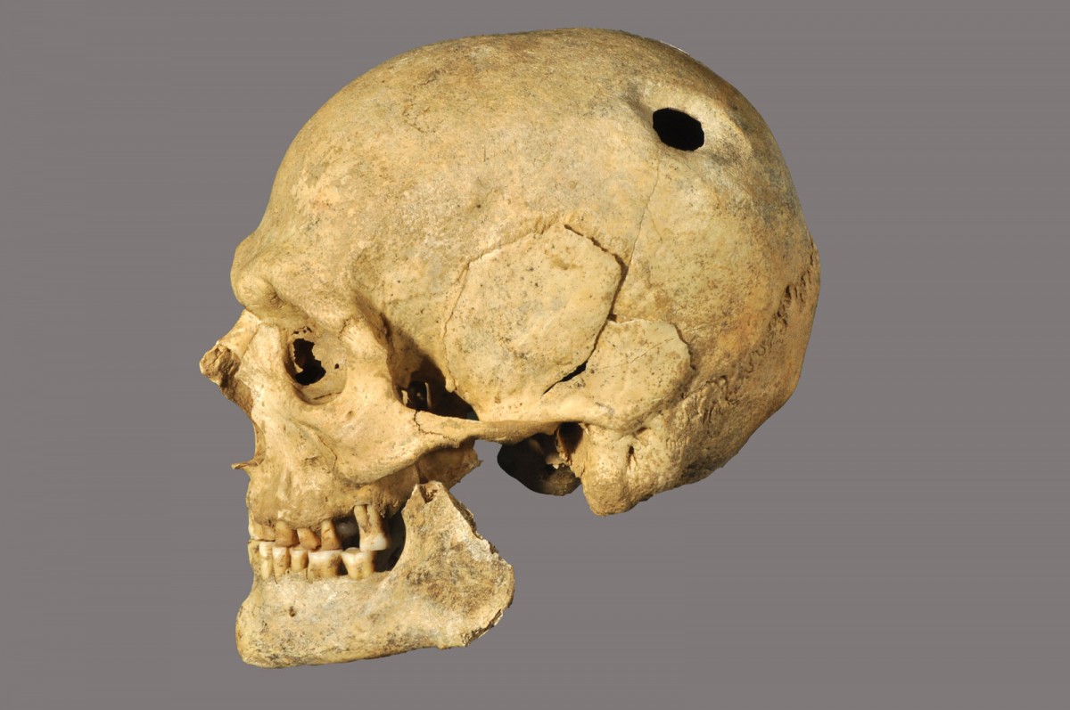 Fig. 31. Skull of a man with traces of surgery (trepanism). 2nd half of the 2nd c. BC. Chios town (Atsiki - Karagiorgi plot).