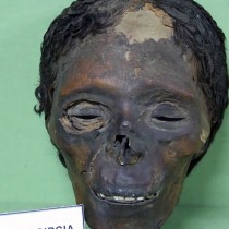 Egyptian mummified head bears traces of dermatosis linked with skin bleaching cosmetics