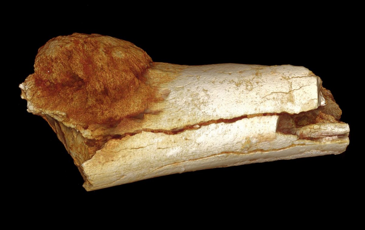 Volume rendered image of the external morphology of the foot bone shows the extent of expansion of the primary bone cancer beyond the surface of the bone.
Credit: Patrick Randolph-Quinney (UCLAN)
