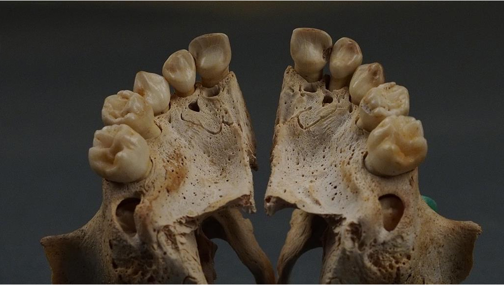 Decay products in the front deciduous teeth of the upper jaw of approx. three years old child. Photo by Jarosław Dąbrowski/Polish Centre of Mediterranean Archaeology UW.