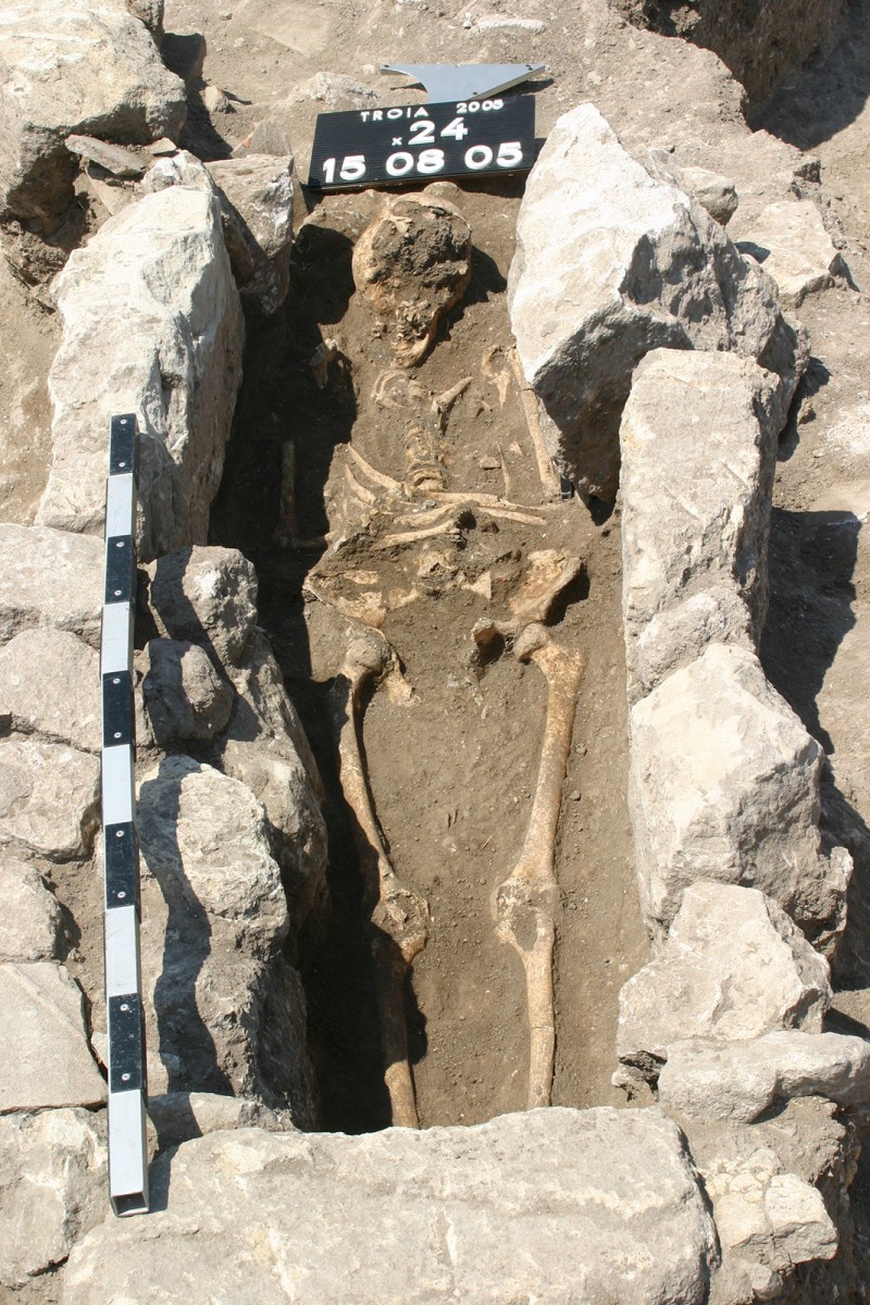 The skeleton of a woman who died 800 years ago on the outskirts of the ancient city of Troy in modern Turkey has yielded the first record of maternal sepsis in the fossil record. DNA locked inside the calcified nodules, found at the base of the chest and extracted by researchers, yielded the complete genomes of the pathogenic bacteria likely responsible for the woman’s death. PHOTO: GEBHARD BIEG 