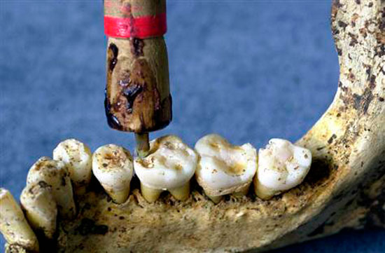 Researchers conduct a re-enactment of the method presumably used in Pakistan to drill teeth 9,000 years ago. A flint drilling tip was mounted in a rod holder and attached to a bowstring. In less than a minute, the technique produced holes similar to those found in prehistoric teeth. One important difference: The Neolithic dentists performed their operations on living humans. Photo credit: Luca Bondioli  /  Nature 