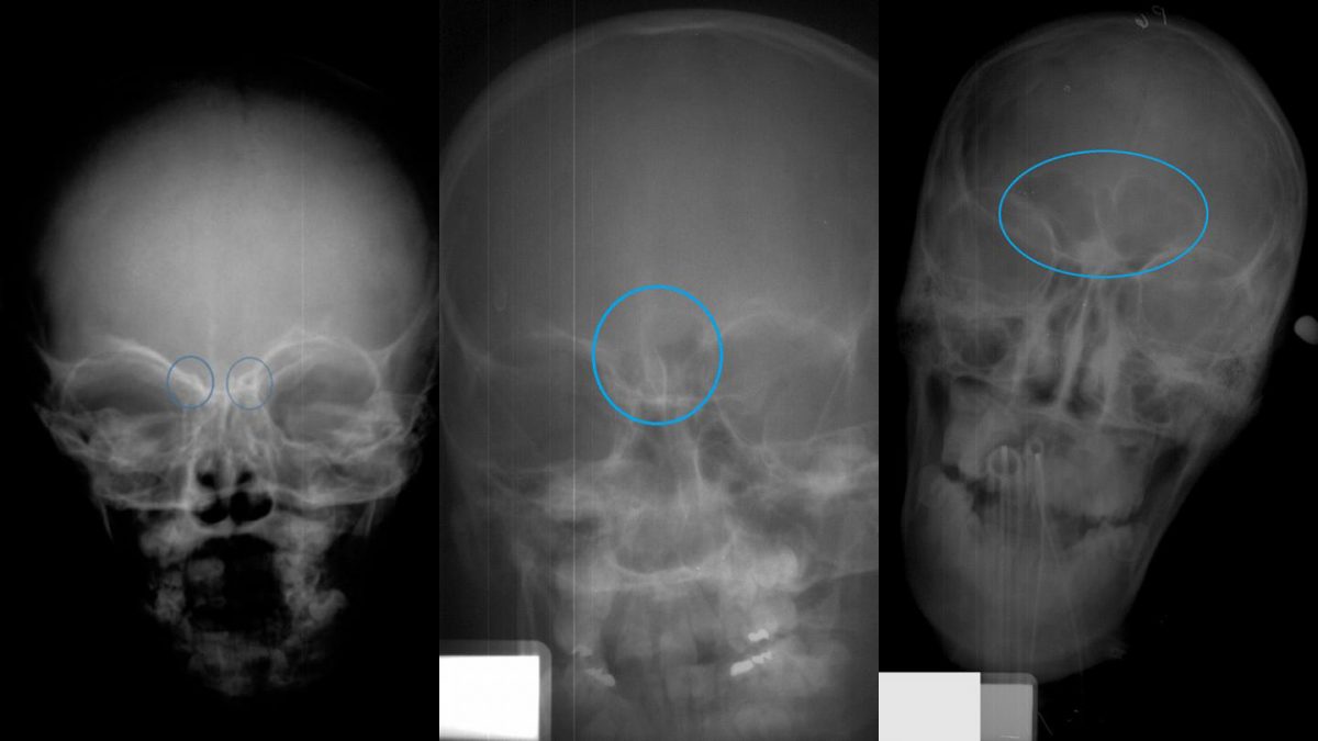 Forensic anthropology researchers at North Carolina State University have developed a technique that can provide an approximate age for juveniles and young people based on an X-ray of the frontal sinus region of the skull. In this image, the skull on the left shows Stage 1 of frontal sinus development (circled in blue). The central skull shows Stage 2. Stage 3 is on the right.
Credit: Ann Ross