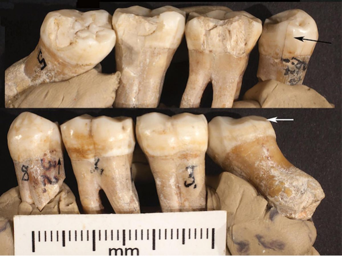 The teeth showed what is being interpreted evidence of primitive attempts to correct problems with them University of Kansas/PA