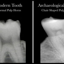 Science meets archaeology with discovery that dental X-rays reveal Vitamin D deficiency