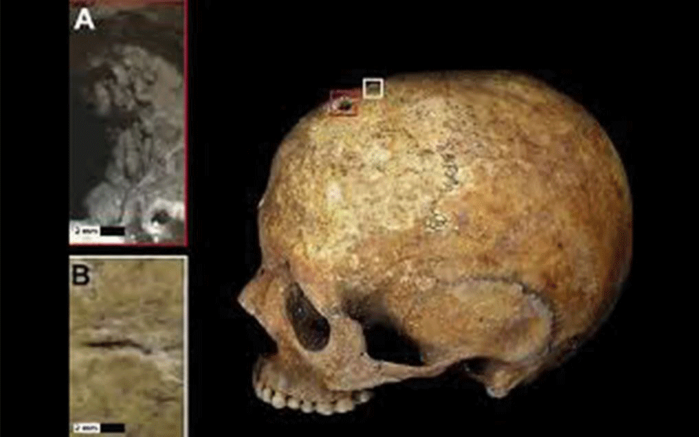 The mother's skull showed a small, circular wound, likely caused during primitive brain surgery called trepanation. A linear cut mark (bottom left) may show where her scalp was peeled back pre-surgery. Image Credit: Pasini et al./World Neurosurgery/Elsevier/Live Science.