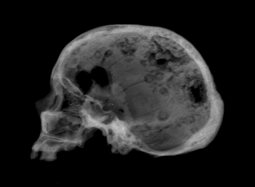 A digitally reconstructed radiograph of the ancient skull reveals the holes caused by cancer.
Image Credit: Courtesy Roberto Miccichè, Giuseppe Carotenuto & Luca Sìneo for LiveScience.