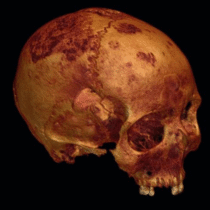Position of Iron age holey skull puzzles scientists