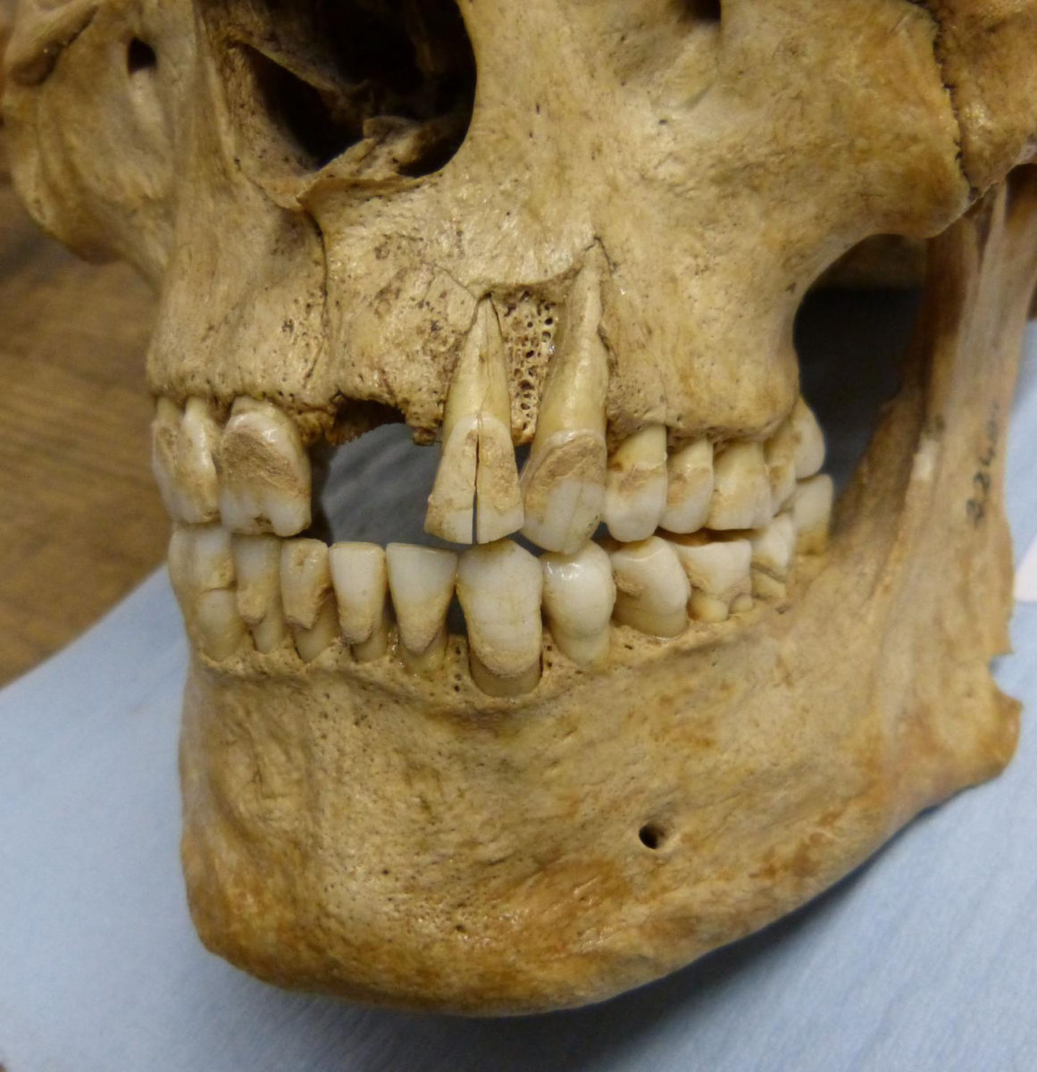 This is a skeleton sampled for the study, dating to the post-medieval period in Britain. The analysis suggests the Victorians were partial to a bowl of porridge, while in modern diets potatoes, soybeans and peanuts are flavour of the day. Credit: Camilla Speller, University of York.