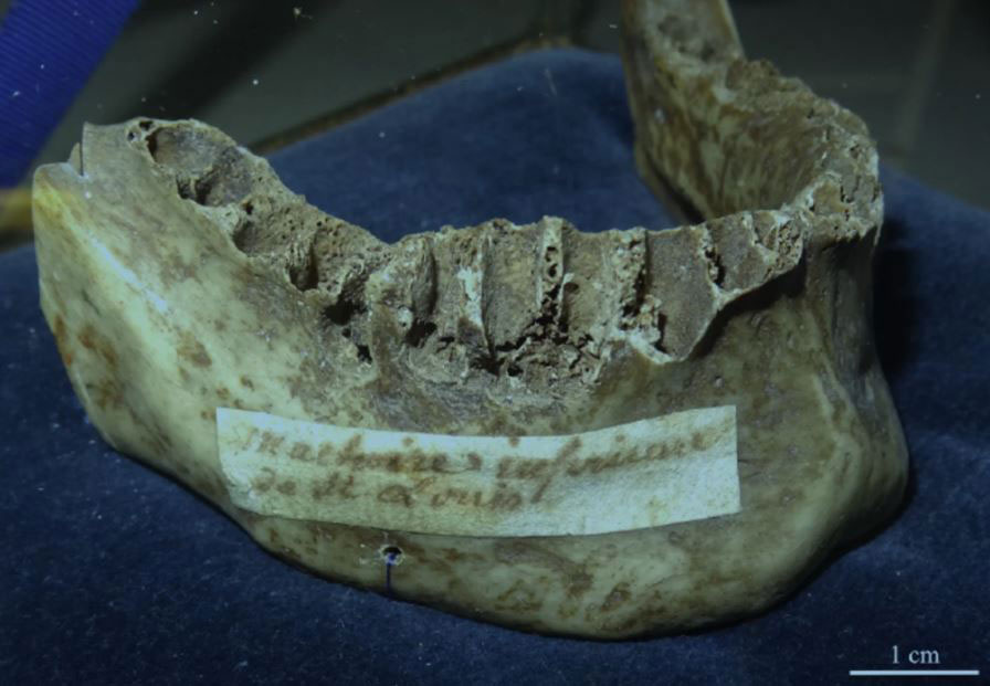 An image of the jaw shows an 18th Century parchment attached identifying it as belonging to Louis IX.
Photo Credit: Charlier P, et al. The mandible of Saint-Louis (1270 AD): Retrospective diagnosis and circumstances of death. J Stomatol Oral Maxillofac Surg (2019)/Live Science.