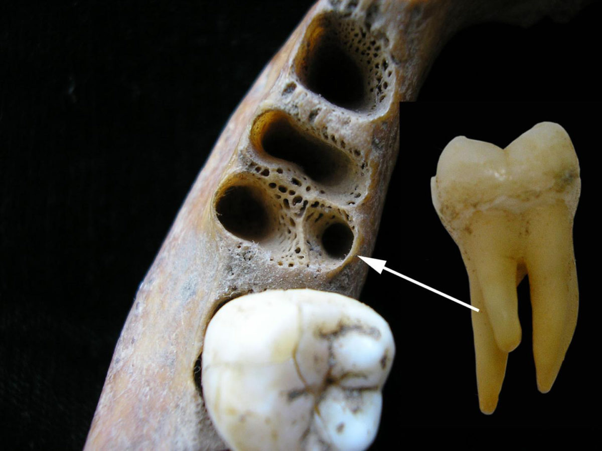 The three-rooted lower molar anomaly in a recent Asian individual. Left: tooth sockets showing position of accessory root; right: three-rooted lower first molar tooth.
Credit: Christine Lee