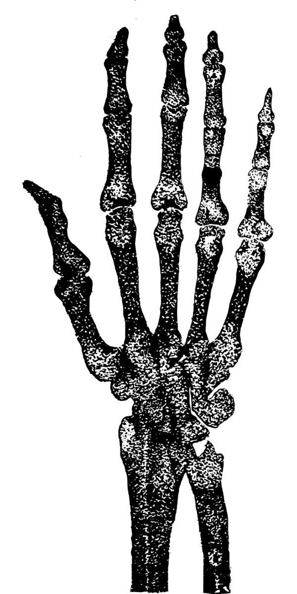 Sex estimation methods using the distal humerus that had been developed on non-Asian individuals were applied to the Thai skeletons. Credit: CC0 Public Domain