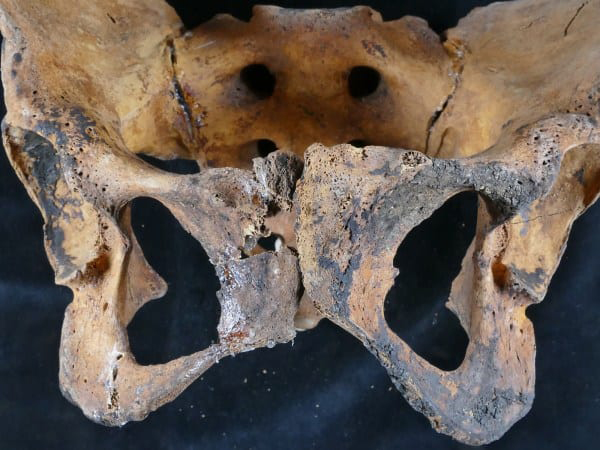 Researchers have found evidence of the oldest gynaecological treatment on record, performed on a woman who lived in Ancient Egypt some 4,000 years ago and died in 1878–1797 BC. Header Image Credit : University of Granada