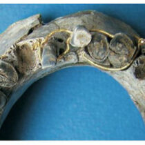 Uncovering the tooth: interventive dental therapy in Ancient Egypt