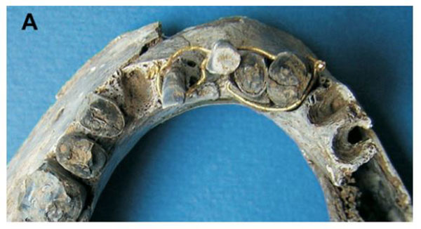 Uncovering the tooth: interventive dental therapy in Ancient Egypt