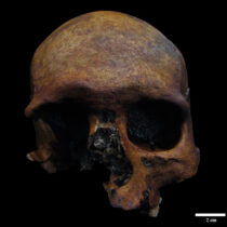 A Roman-period cranial tumor case is detected