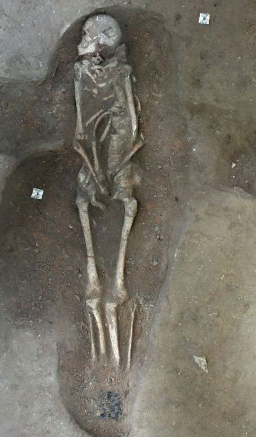 A skeleton with Jacob's syndrome. Image credit: Network Archaeology.