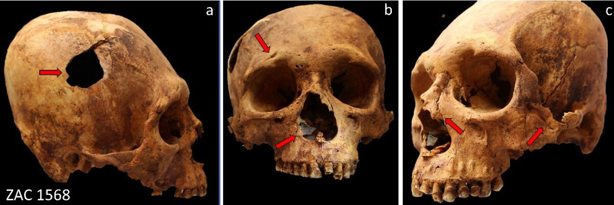 Various traumatic injuries in one of the individuals studied: a) perimortem penetrating fracture in right parietal produced by blunt force trauma; b) cut mark in right superciliary arch relating to sharp force trauma, and perimortem injury relating to stone flake, which remains embedded in right wall of nasal pyriform aperture; c) healed linear penetrating fracture and cut marks in left zygomatic bone relating to sharp-blunt force trauma, and healed nasal fracture (photos: Luis Pezo-Lanfranco)