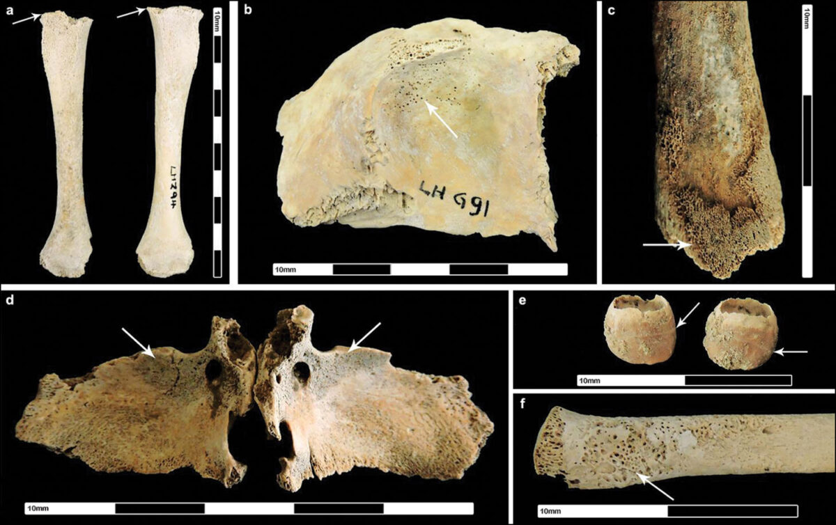 Indicators of stress on adult female skeletons dating to the Roman period. Pitt 2025, © Antiquity Publications Ltd.