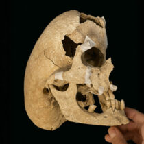 Crouzon syndrome in a knight from the Order of Calatrava